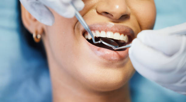 Emergency Dental Filling Replacement in SD